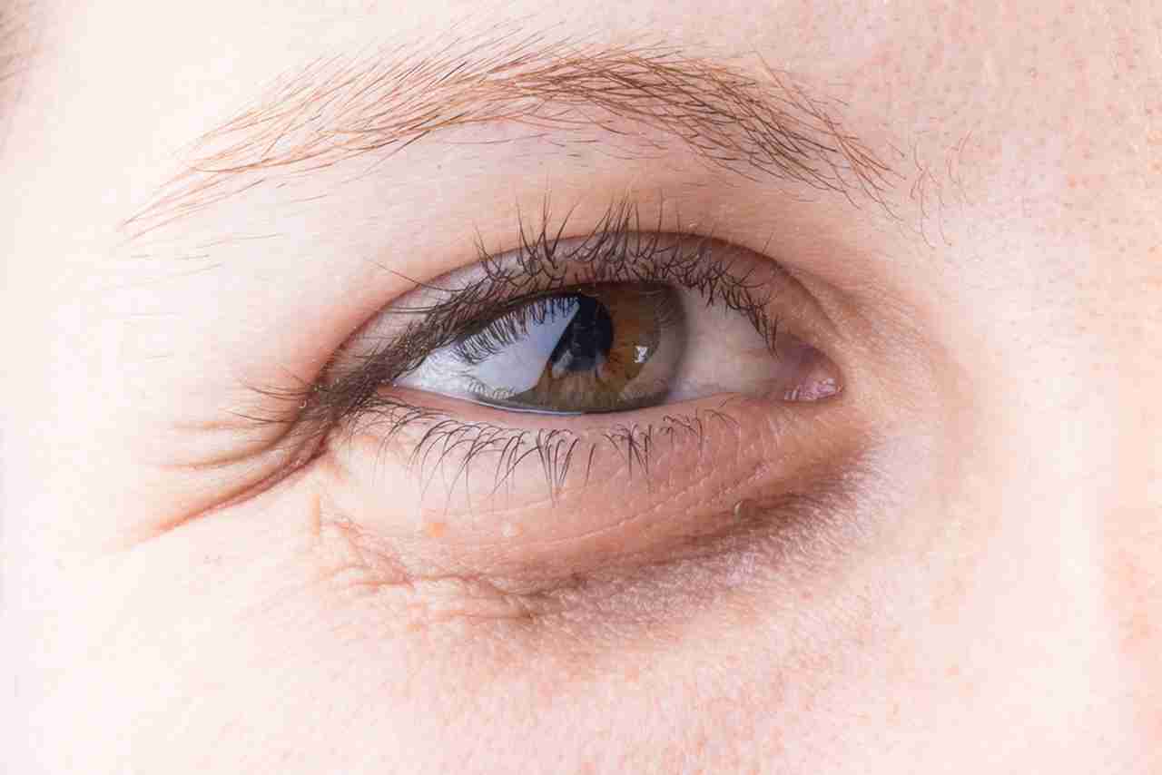 اسباب ظهور الهالات السوداء تحت العين وعلاجه